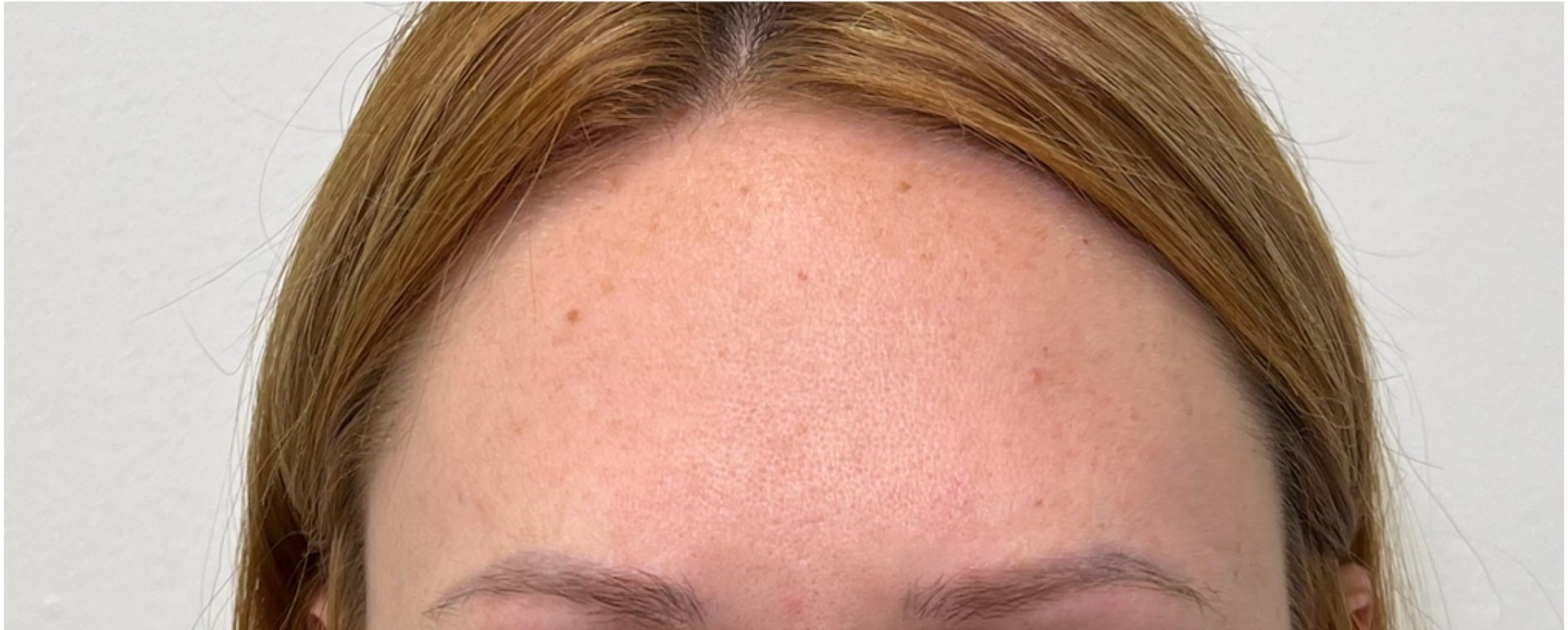 After tox treatment at Push Med in Greenville, SC: the same area smooth with a relaxed, natural expression