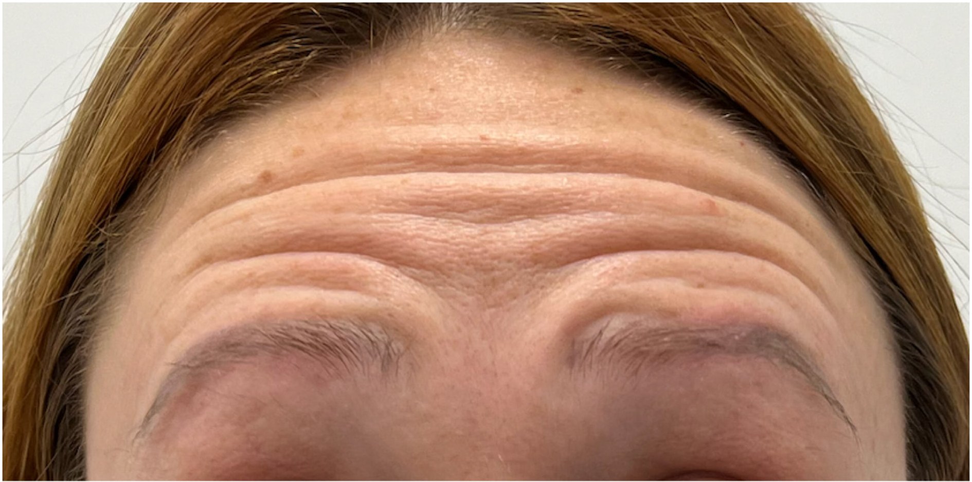 Before tox treatment at Push Med in Greenville, SC: forehead lines visible when raising the brows