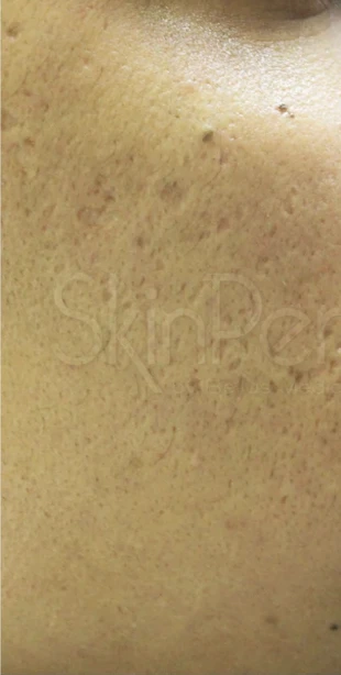 Acne scars after five SkinPen microneedling treatments