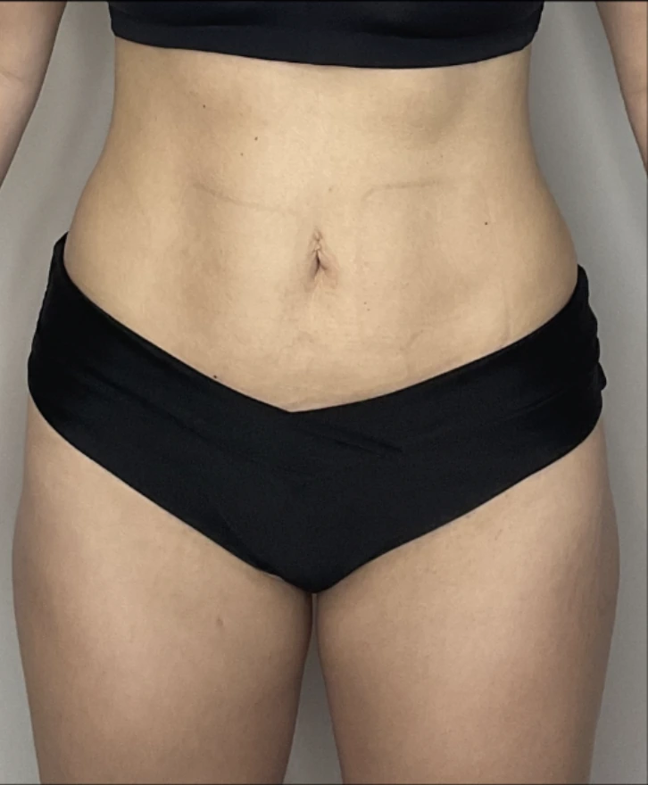After six PHYSIQ body contouring sessions: the same front view with a flatter, smoother lower abdomen and tighter skin