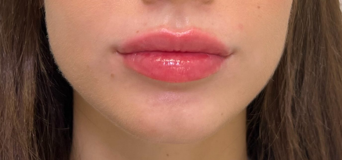 After lip filler at Push Med in Greenville SC, front view