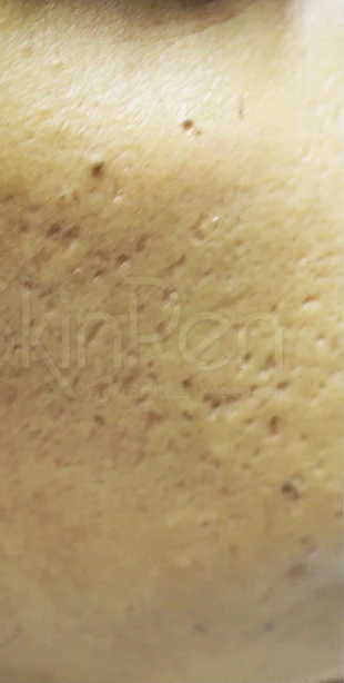 Acne scars before SkinPen microneedling