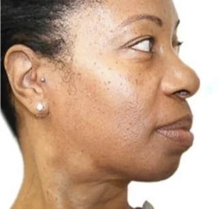 After three VI Peel Precision Plus treatments over three months: the same side profile with a noticeably more even skin tone