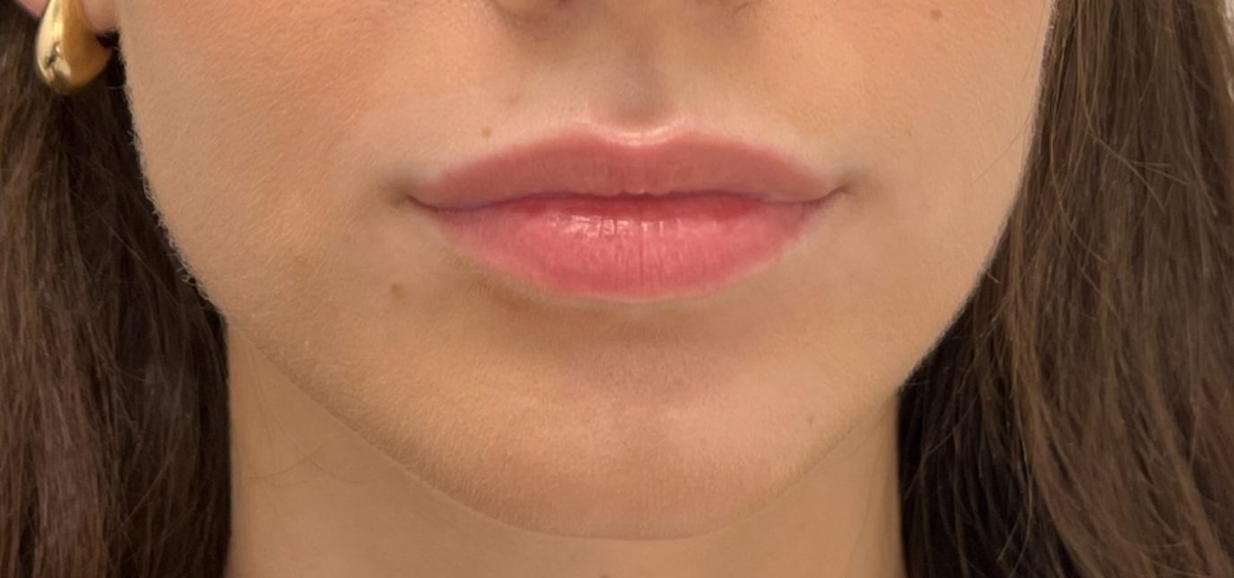 Before lip filler at Push Med in Greenville SC, front view