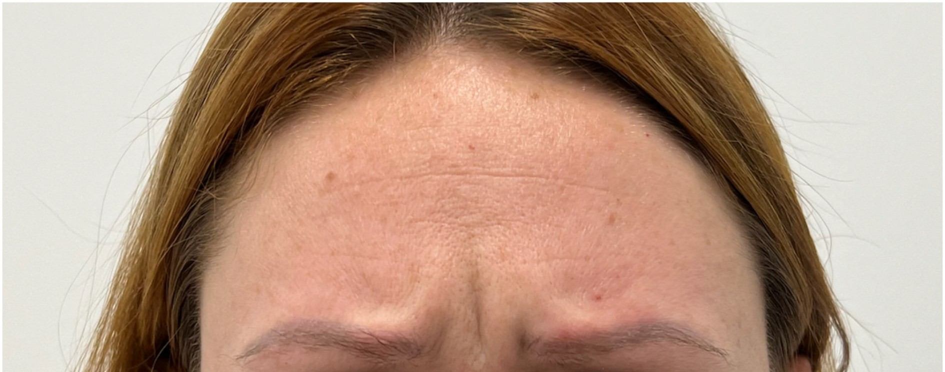Before tox treatment at Push Med in Greenville, SC: frown lines between the brows when squinting