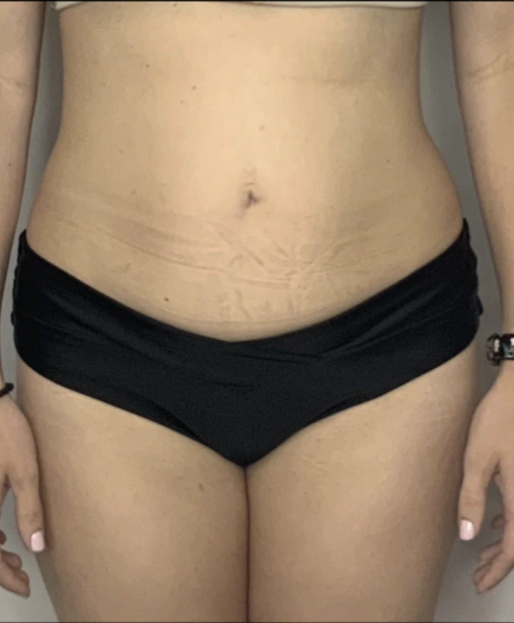 Before a series of PHYSIQ body contouring sessions: front view of a woman's abdomen and hips showing loose skin and folds above the waistband