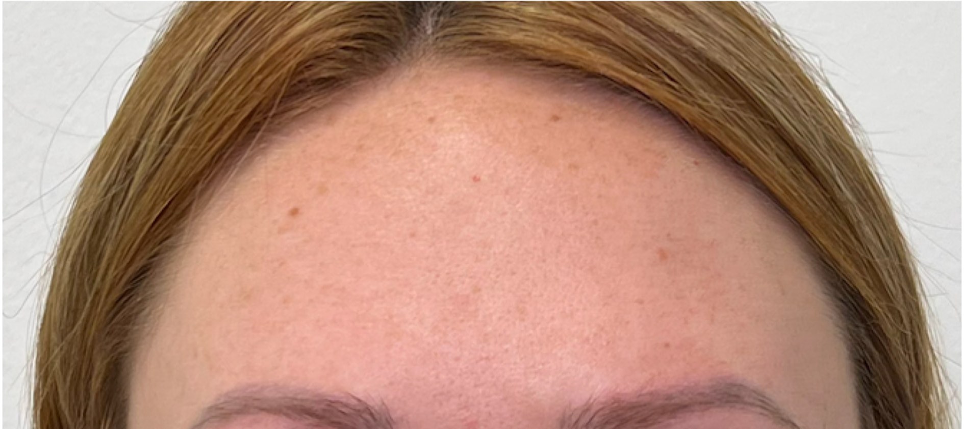 After tox treatment at Push Med in Greenville, SC: the same forehead smooth and relaxed with brows at rest