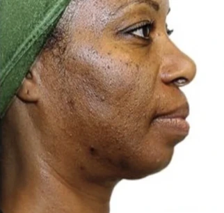 Before a series of VI Peel treatments: side profile showing dark patches of hyperpigmentation and uneven texture across the cheek and jaw